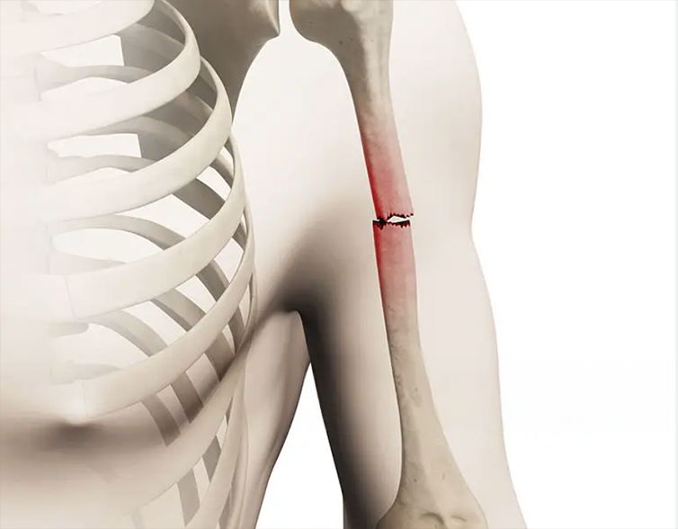 Fractura de humerus