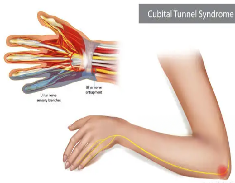 Sindromul de nerv ulnar