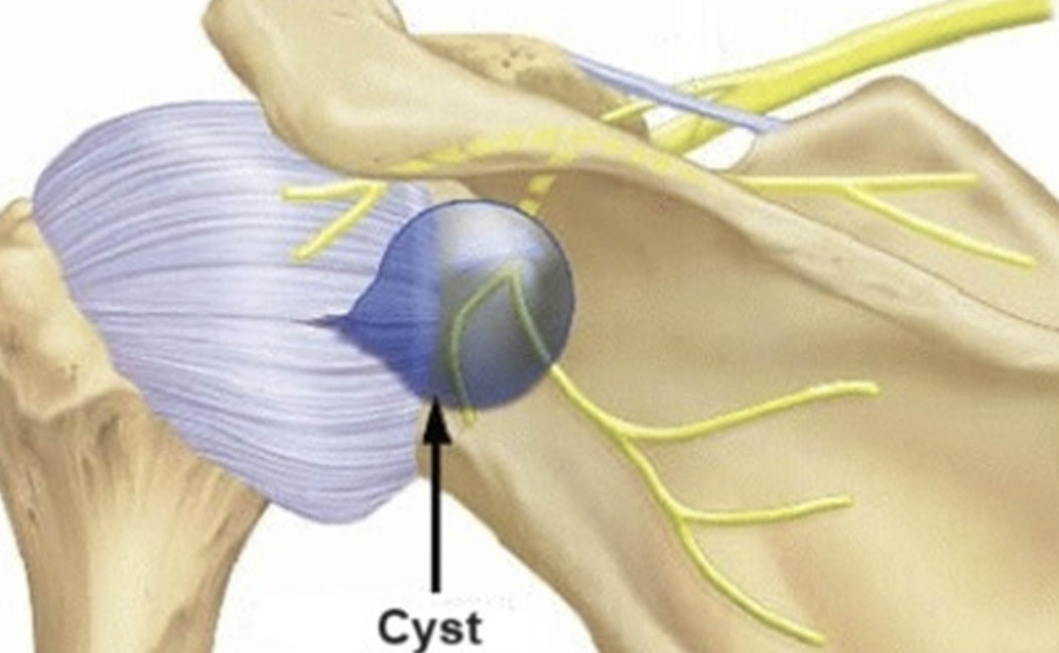 Chistul sinovial al umarului