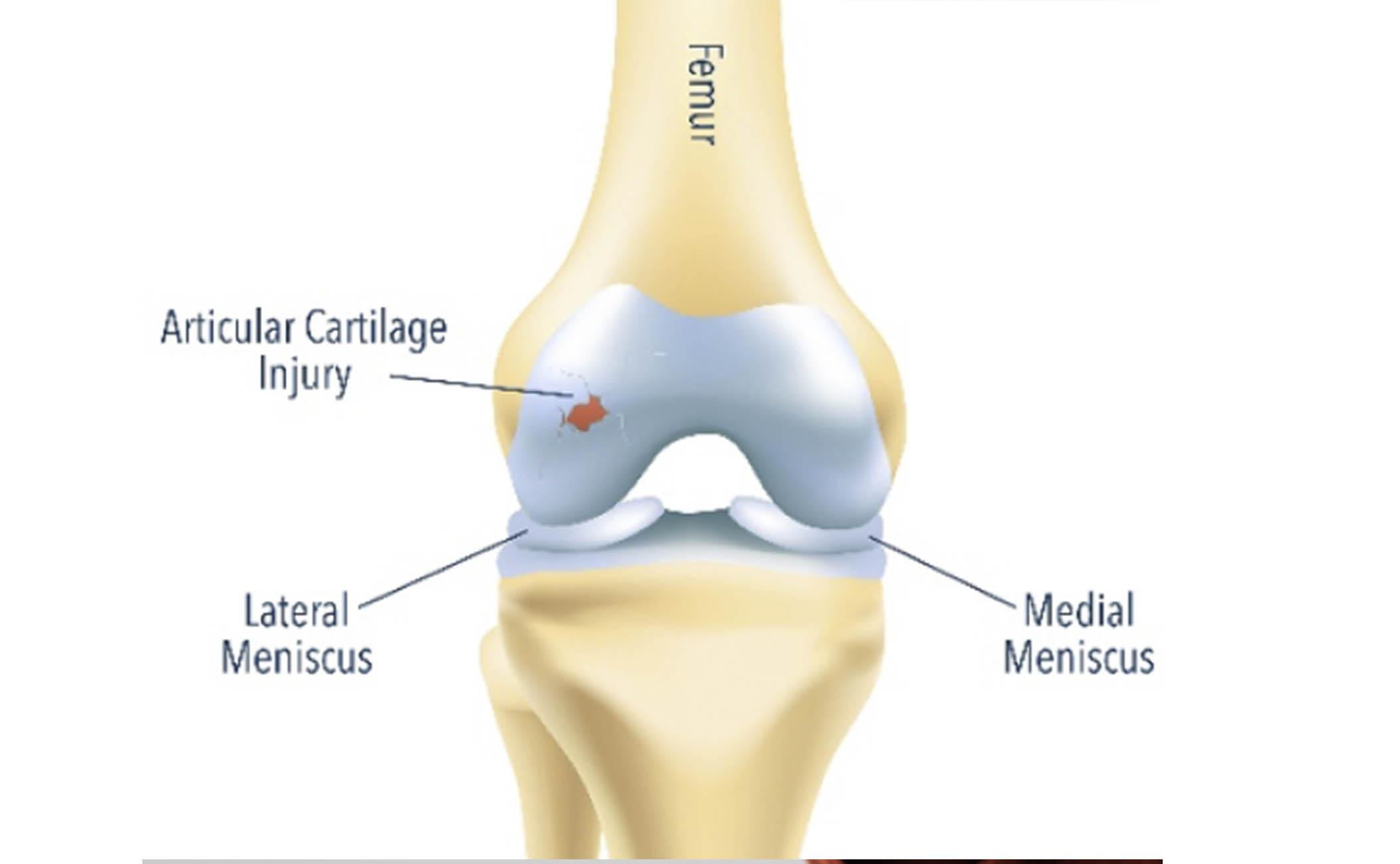 Defectul de cartilaj articular